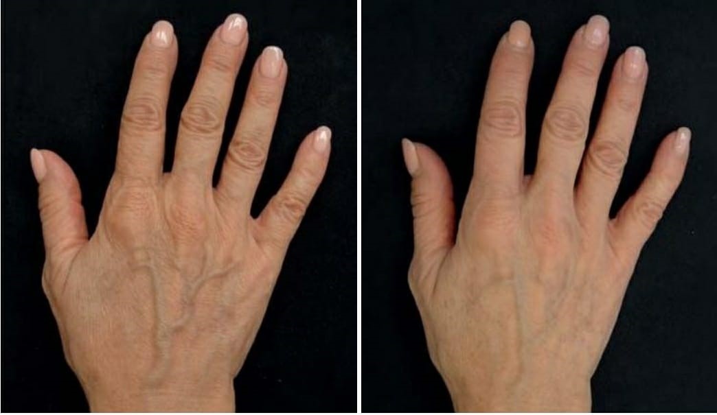 Bioremodelación con Profhilo