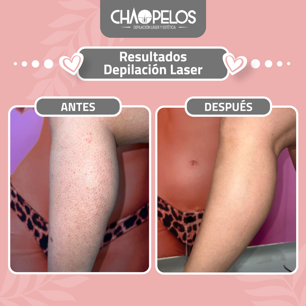 Piernas Cuantas Sesiones Fotodepilacion Se Necesitan Vello Como